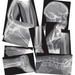 Broken Bones X-Rays